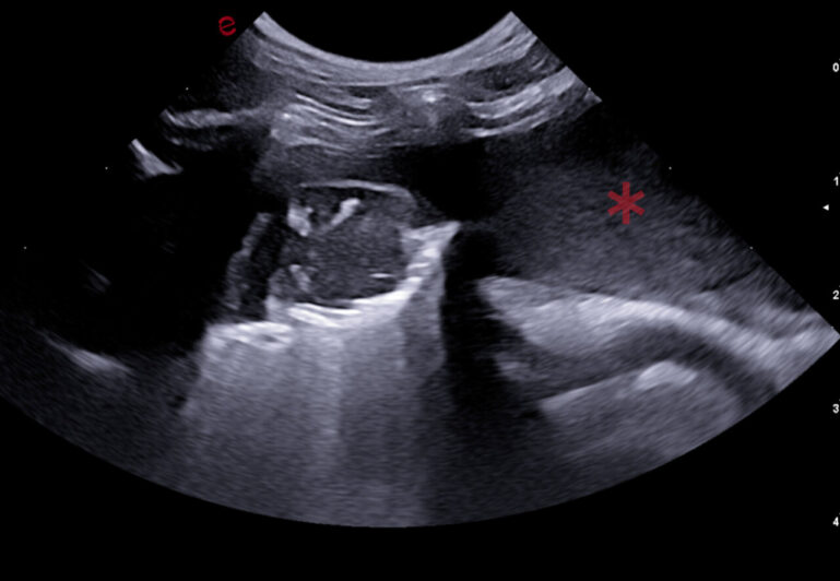 Ecografía de tórax en la que se muestra efusión pleural (asterisco).