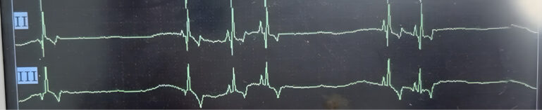 Gráfico de un electrocardiograma en derivación II y III a 20 mm/mV de un perro con síndrome de seno enfermo, en el que se observa un periodo de arresto sinusal.