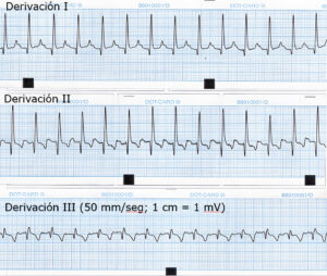 Electrocardiograma mostrando derivaciones I, II y III con líneas de tiempo.