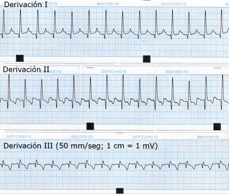 Electrocardiograma mostrando derivaciones I, II y III con líneas de tiempo.