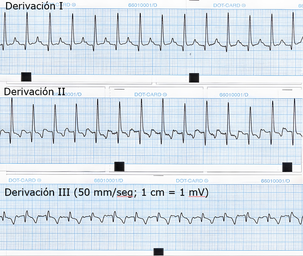 Electrocardiograma mostrando derivaciones I, II y III con líneas de tiempo.