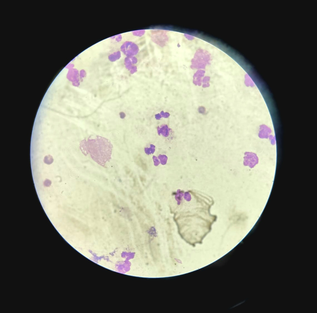 Citología de líquido pleural con neutrófilos degenerados y bacterias.