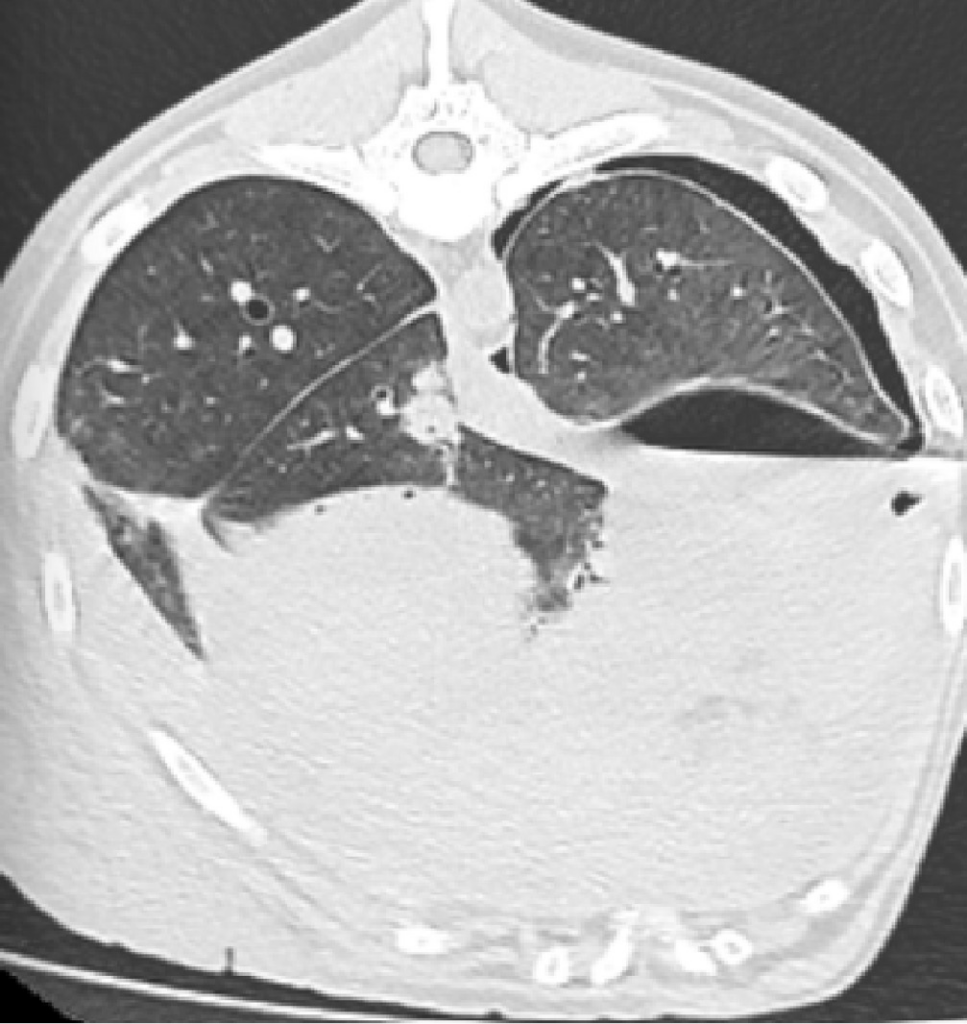 Tomografía computarizada de los pulmones mostrando detalles internos