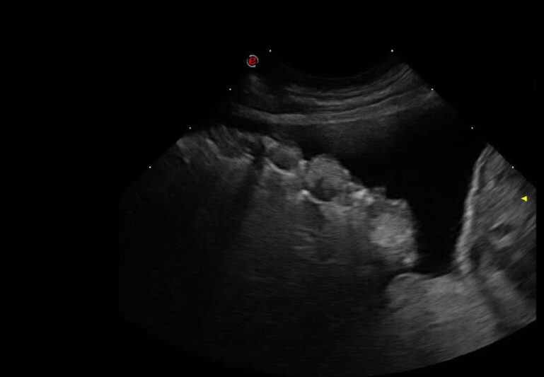 Ecografía torácica: efusión pleural y múltiples nódulos redondeados en la superficie pulmonar.