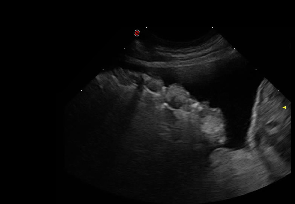 Ecografía torácica: efusión pleural y múltiples nódulos redondeados en la superficie pulmonar.