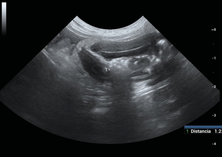 Ecografía abdominal de un perro: corte oblicuo de yeyuno, donde se evidencia una estructura alargada e hiperecoica (cuerpo extraño)