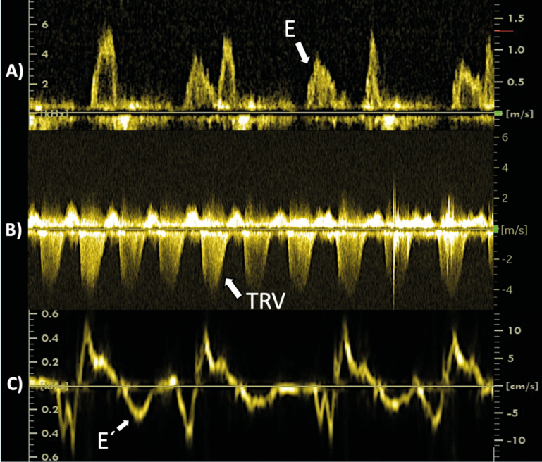 Identificación de importantes determinaciones ecocardiográficas empleando la tecnología Doppler en un perro parasitado por Dirofilaria immitis.