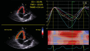 Ecocardiografía mediante método de speckle tracking bidimensional compatible con hipertensión pulmonar en un perro parasitado por Dirofilaria immitis.