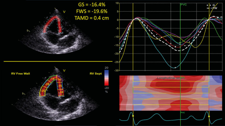 Ecocardiografía mediante método de speckle tracking bidimensional compatible con hipertensión pulmonar en un perro parasitado por Dirofilaria immitis.