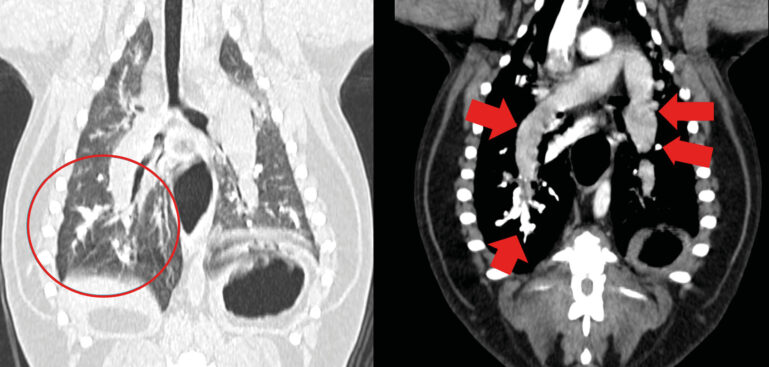Imagen torácica compatible con trombos mineralizados y grave dilatación en las arterias pulmonares caudales derivados de la infección por Dirofilaria immitis y su tratamiento en un paciente canino.