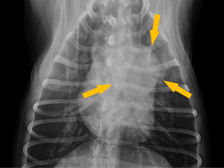 Grave dilatación de la silueta del tronco pulmonar en una proyección dorsoventral en un paciente canino con dirofilariosis cardiopulmonar.