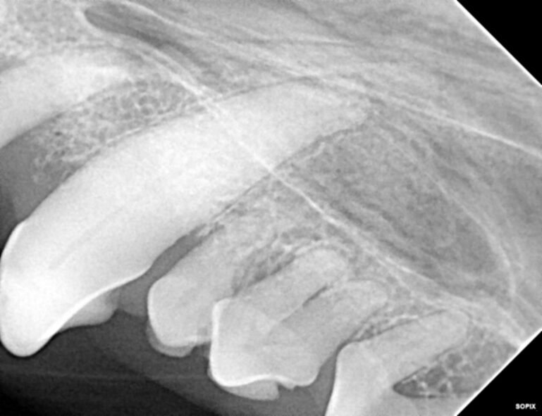 La evaluación radiográfica intraoral prequirúrgica es un paso imprescindible para evaluar la anatomía radicular y planificar la estrategia de extracción.