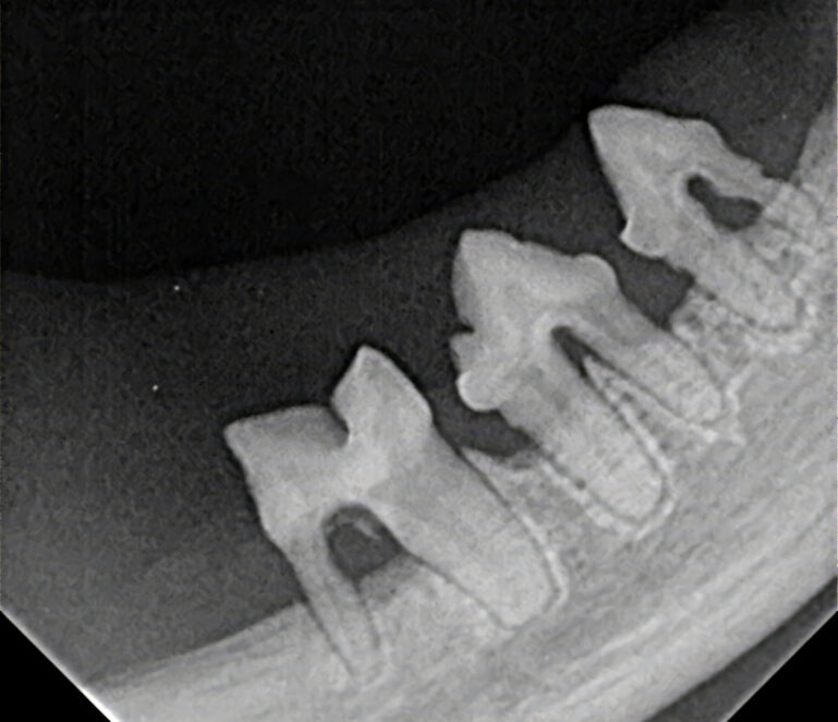 Estudio radiográfico intraoral del mismo paciente de la imagen 3, que evidencia pérdida ósea alveolar horizontal y afectación de furcas compatible con enfermedad periodontal avanzada.