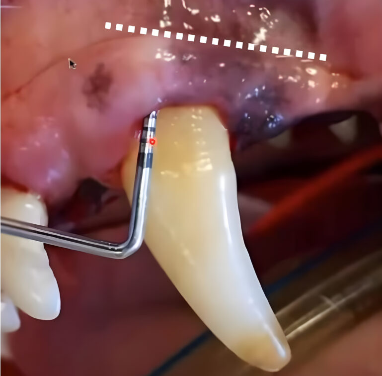 Empleo de la sonda periodontal en odontología veterinaria.