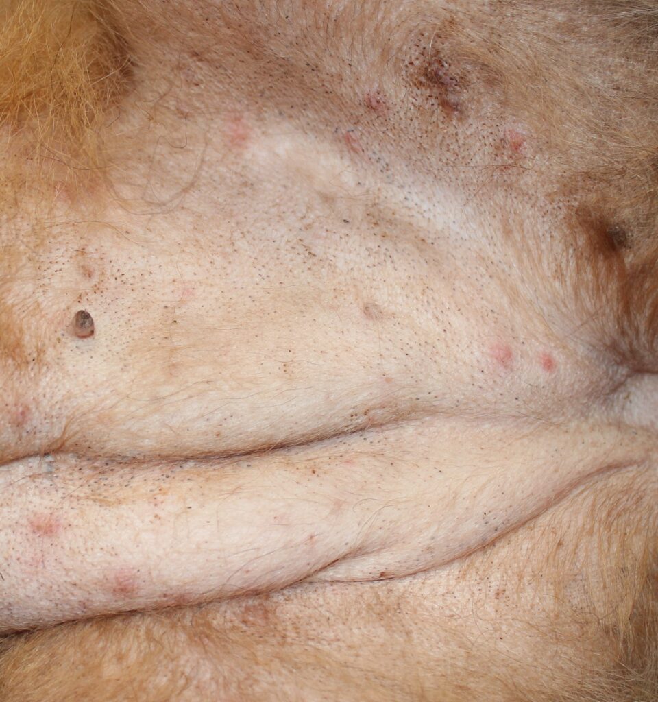 Pápulo-pústulas y tapones foliculares en el abdomen.